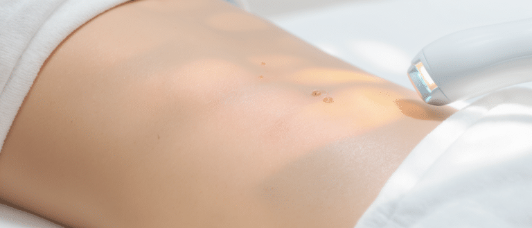 Emtone : la solution innovante contre la cellulite