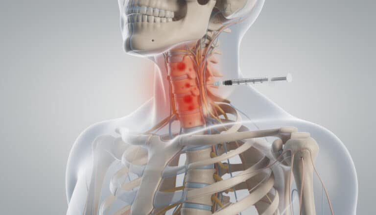 Illustration anatomique d'une infiltration cervicale avec injection guidée au niveau du cou montrant les structures nerveuses et vasculaires