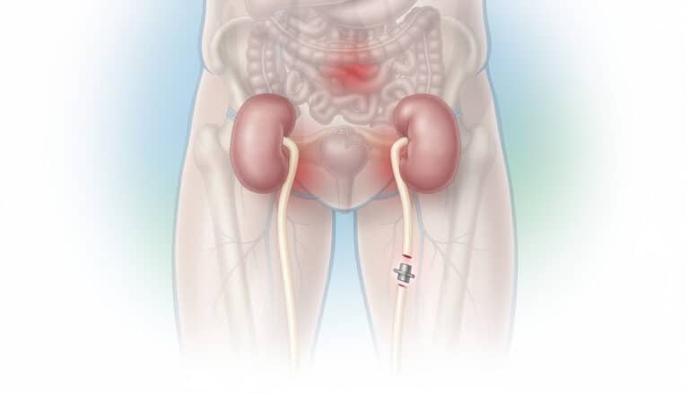 découvrez tout ce qu'il faut savoir sur la douleur après une vasectomie et les méthodes efficaces pour la gérer au mieux.