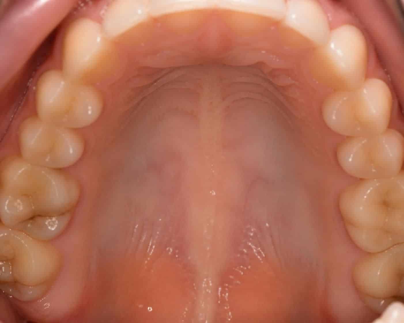 découvrez les causes courantes de la douleur au palais, comment identifier ses symptômes et les solutions efficaces pour soulager cet inconfort rapidement.