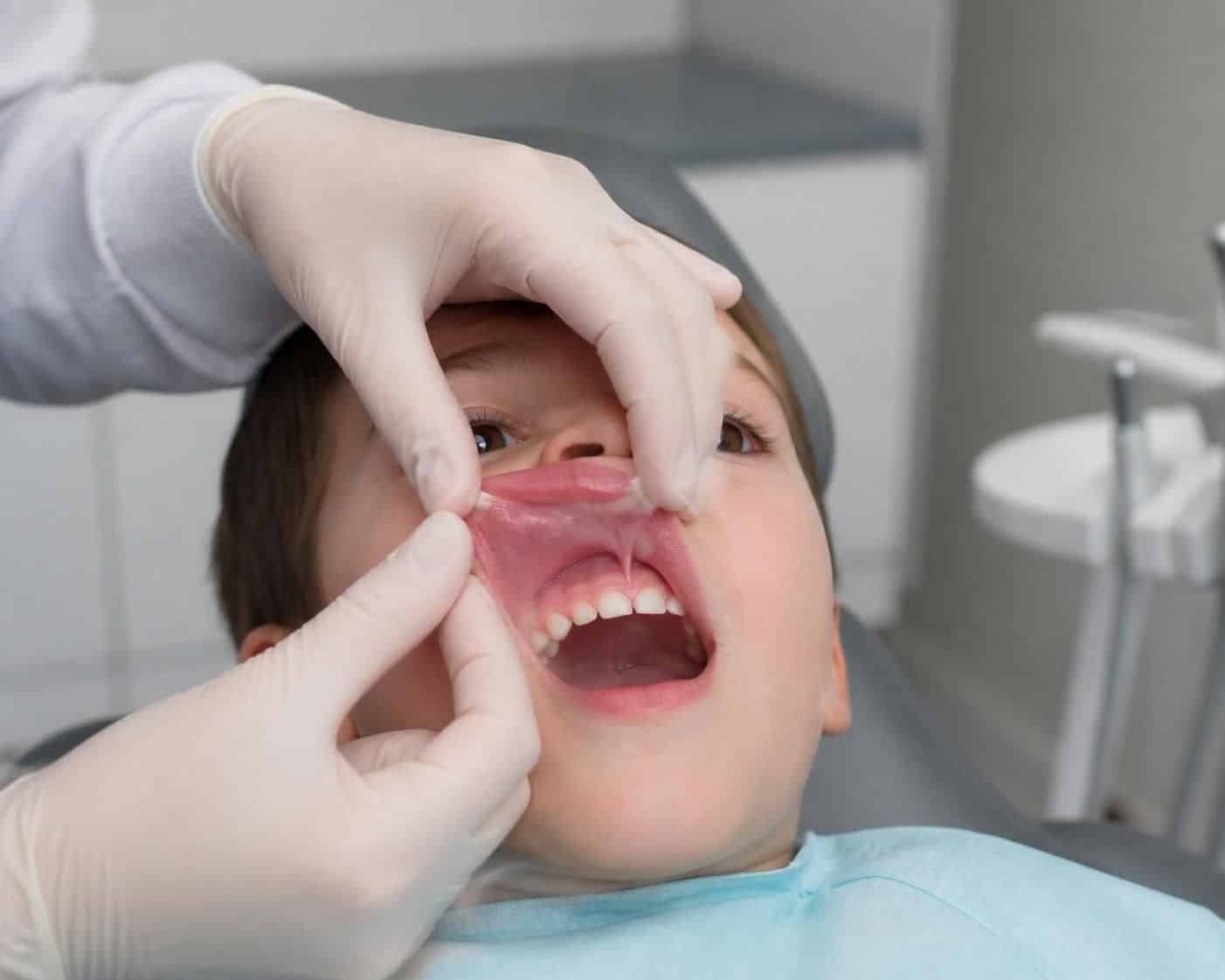 découvrez tout ce qu'il faut savoir sur le frein labial supérieur, son rôle, ses impacts sur la santé bucco-dentaire et les solutions possibles.