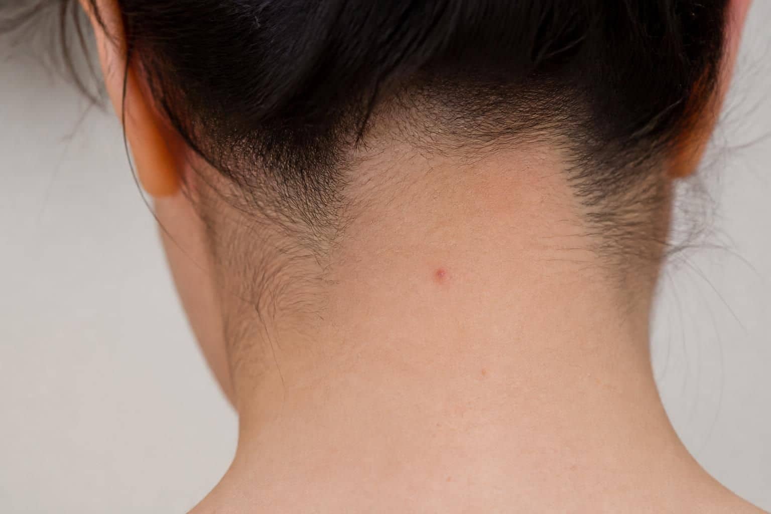 découvrez les causes, symptômes et solutions efficaces pour traiter le bouton sur la nuque des cheveux et retrouver un cuir chevelu sain.