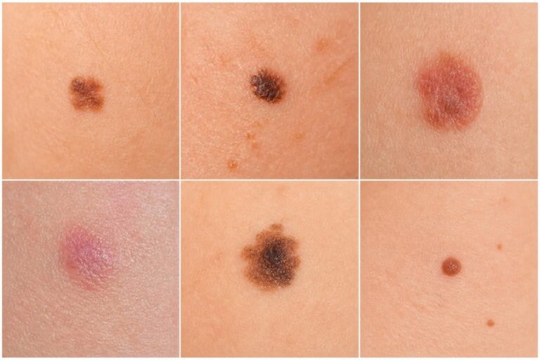 Six gros plans de taches cutanées brunes ou rougeâtres aux formes et teintes variées