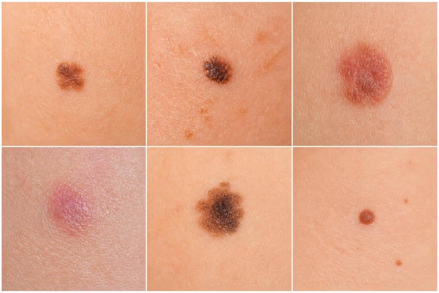 Six gros plans de taches cutanées brunes ou rougeâtres aux formes et teintes variées