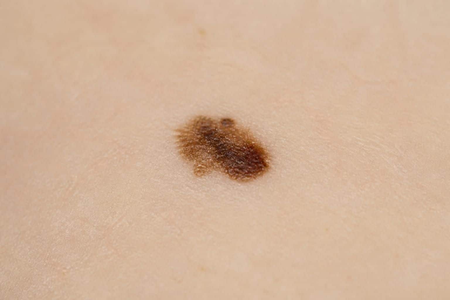 apprenez à identifier un grain de beauté dangereux grâce à une photo avec nos conseils essentiels pour prévenir les risques et protéger votre peau.